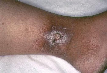 Agressive House Spider Bite
